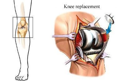 knee replacement Delhi
